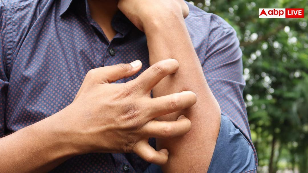 Bug Bite Itching: मच्छर या कीड़ा काटे तो खुजली करने से पहले 2 बार सोचें, रिसर्च में हुआ बेहद चौंकाने वाला खुलासा