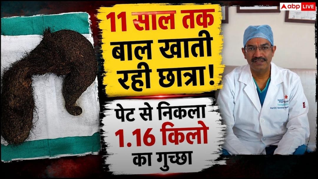 11 साल से अपने बाल खा रही थी छात्रा, पेट से निकला 1.16 किलो का गुच्छा